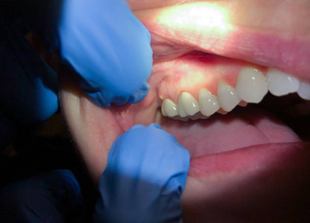 Best Urgent Care for Lost Fillings or Crowns in Landen, OH
