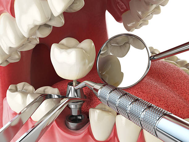Best Emergency Root Canal Treatment in Landen, OH